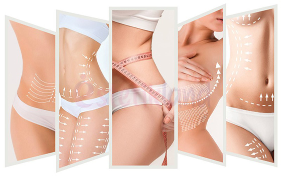 liposuction1.jpg